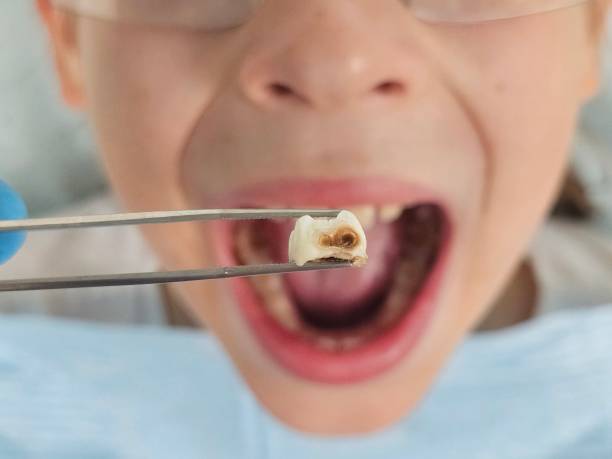 Best Emergency Treatment for Toothache in Quitman, MS